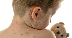 Unicef: Sarampo no Brasil tem avanço preocupante Surto Sarampo