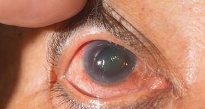 Glaucoma 2019