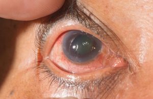Glaucoma 2019