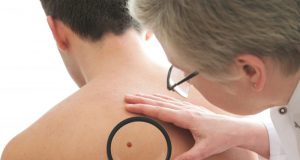 Dezembro Laranja: conheça a ‘regra do A,B,C,D,E’, método de identificação do melanoma