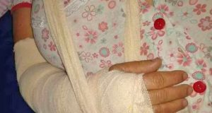 Durante agressão marido quebra o braço da esposa