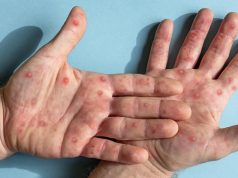 Instituto Adolfo Lutz confirma o primeiro caso de – MPOX (varíola dos macacos) em Araraquara