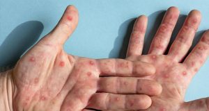 Instituto Adolfo Lutz confirma o primeiro caso de – MPOX (varíola dos macacos) em Araraquara