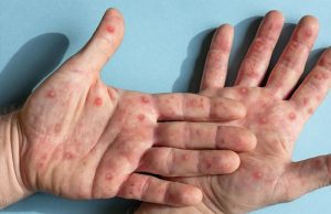 Instituto Adolfo Lutz confirma o primeiro caso de – MPOX (varíola dos macacos) em Araraquara